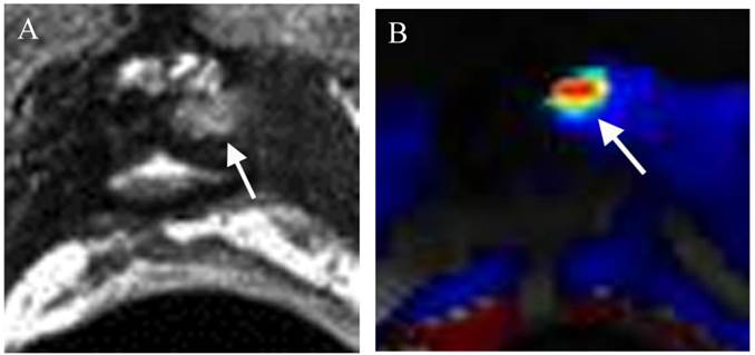 J Cancer Image