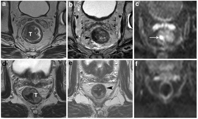 J Cancer Image