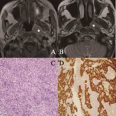 J Cancer Image