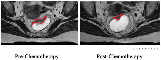 J Cancer Image