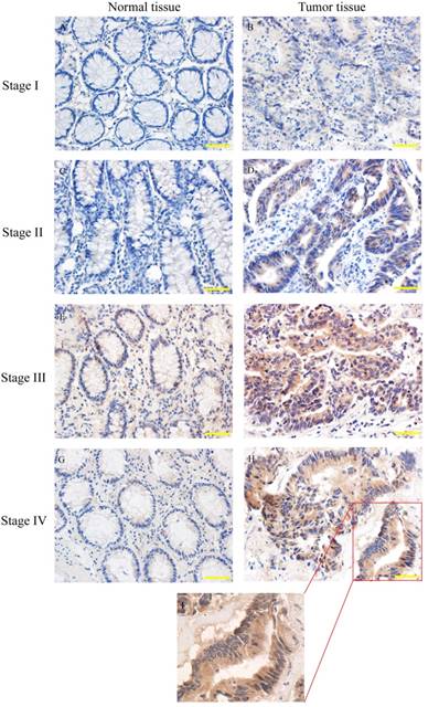 J Cancer Image