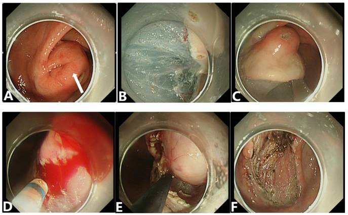 J Cancer Image