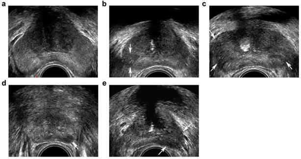 prostate nodule ultrasound