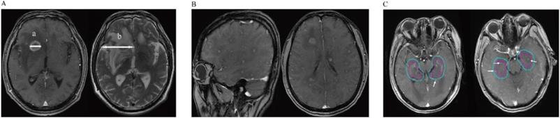 Radiographic Features of Metastatic Brain Tumors from ALK-rearranged