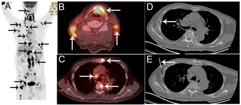 A Retrospective Study of predicting risk of Metastasis among FDG-avid ...